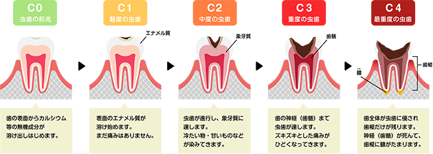 虫歯の進行