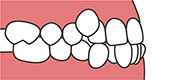 歯の重なり・ねじれ
