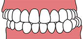 左右にずれた咬み合わせ