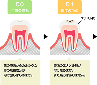 虫歯の進行1