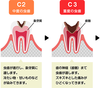 虫歯の進行2