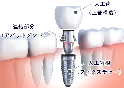 インプラントのしくみ